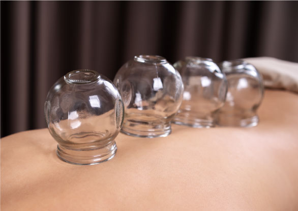 Cupping at Valley Massage Clinic